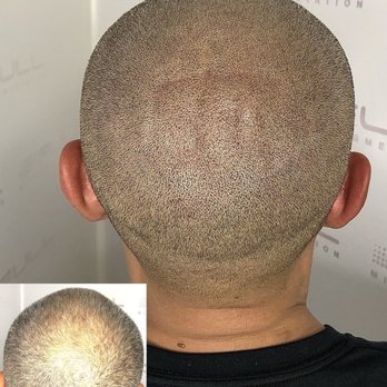 Full Micropigmentation - Hair Loss Centers Near Me - Las Vegas, Nevada Full Micropigmentation - Hair Loss Centers Near Me - Las Vegas, Nevada