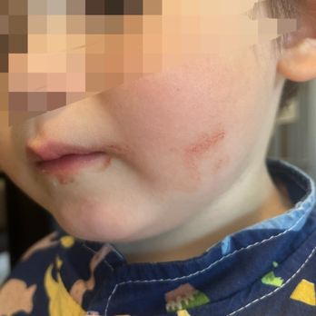 Chick-fil-A - My son's face covered with blood after play in their play room - Fast Food Near Me - Ladera Ranch, California Chick-fil-A - My son's face covered with blood after play in their play room - Fast Food Near Me - Ladera Ranch, California