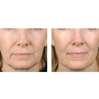 Steven B. Hopping, MD - Platelet Rich Plasma Treatment - Cosmetic Surgeons Near Me - Washington, DC, District of Columbia Steven B. Hopping, MD - Platelet Rich Plasma Treatment - Cosmetic Surgeons Near Me - Washington, DC, District of Columbia