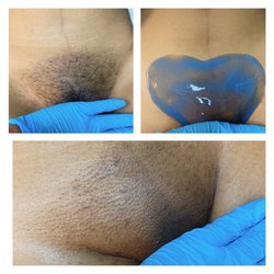 MBS Esthetics - Before and after pics of a vajacial