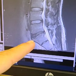 cherry creek family practice - Recent M.R.I of my lower back.