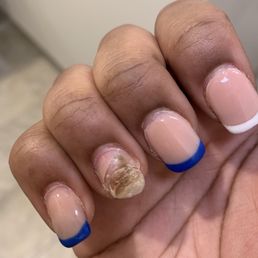 My nail broke after a week and now I have an infection under my nails My nail broke after a week and now I have an infection under my nails