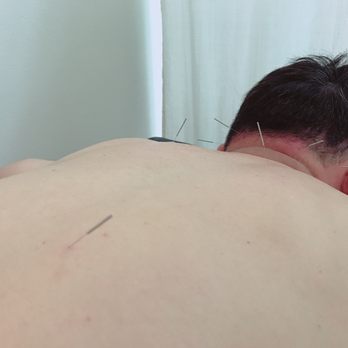 Pine Tree Acupuncture - Acupuncture Near Me - Fullerton, California Pine Tree Acupuncture - Acupuncture Near Me - Fullerton, California