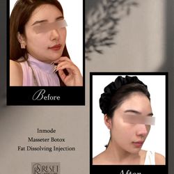 Reset Laser Clinic by Lavender Skin Care Inc - InMode RF Skin Tightening & Contouring
Lift, tighten, and sculpt your face and body with InMode