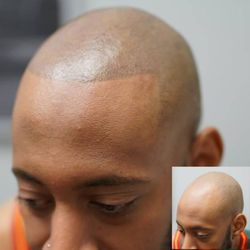 Jackson Lamar - His first session out of three for scalp micropigmentation!!!