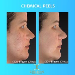 Cerulean Medical Institute - Chemical peels at Cerulean Medical Institute in Kelowna BC for rejuvenated healthy youthful skin