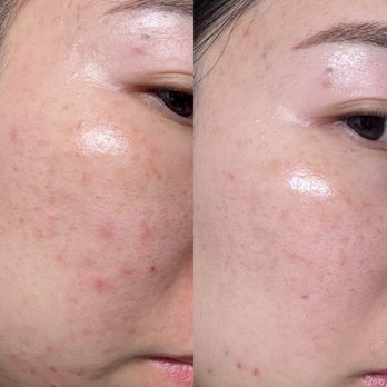 Avanti Laser Clinic - Skin Care Near Me - Fullerton, California
