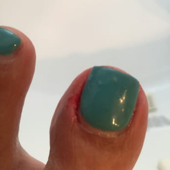 Dreams Nails & Spa - Here's a pic of my big toe, swelling and bleeding. - Nail Salons Near Me - Camarillo, California Dreams Nails & Spa - Here's a pic of my big toe, swelling and bleeding. - Nail Salons Near Me - Camarillo, California