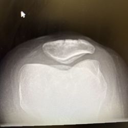 Romano Orthopaedic Center - Left patela