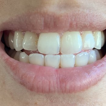 Vivid Smiles Express - After - Teeth Whitening Near Me - Beverly Hills, California Vivid Smiles Express - After - Teeth Whitening Near Me - Beverly Hills, California