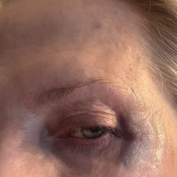 dermani MEDSPA® Peachtree City - Botox injections