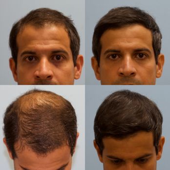 Carolina Hair Surgery - Before & After - Hair Loss Centers Near Me - Fort Mill, South Carolina Carolina Hair Surgery - Before & After - Hair Loss Centers Near Me - Fort Mill, South Carolina