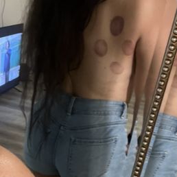 Cupping massage