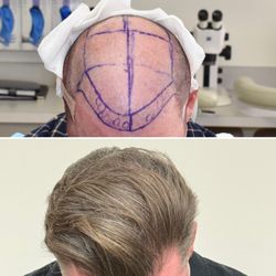 Client had all 4 zones restored with almost 7200 FUE grafts by 2 separate procedures. More density still to come.