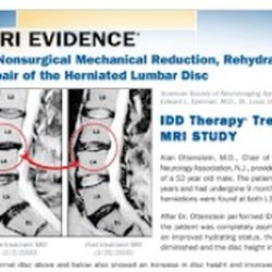 Coral Way Disc Center - MRI evidence of rehydration and disc repair using Non-Surgical Spinal Decompression