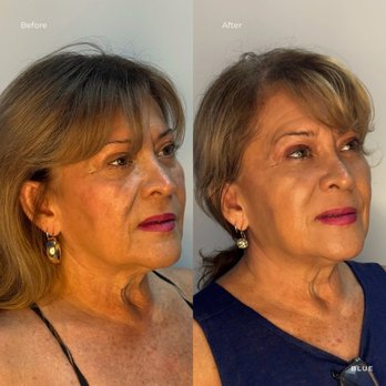 Blue Medi Spa - Skin Care Near Me - Sherman Oaks, California Blue Medi Spa - Skin Care Near Me - Sherman Oaks, California