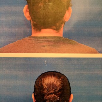 Barrett Plastic Surgery - Otoplasty - Cosmetic Surgeons Near Me - Beverly Hills, California