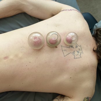 Treating the Root - Cupping therapy treatment on a local veteran - Skin Care Near Me - Watertown, New York