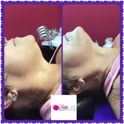 Lush Life Body Contouring - FaceLift