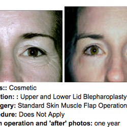 Ronald E Iverson, MD, FACS - Before & After Eyelid Surgey