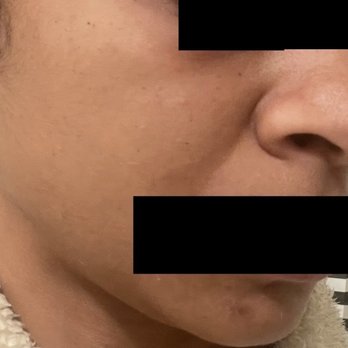 Epione - Malar Edema experienced after receiving dark circle treatment at Epione - Skin Care Near Me - Beverly Hills, California Epione - Malar Edema experienced after receiving dark circle treatment at Epione - Skin Care Near Me - Beverly Hills, California