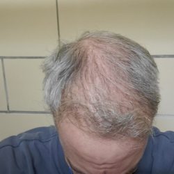 Bosley Hair Restoration & Transplant