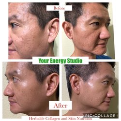 Your Energy Studio - Nourish from within. Have acne? scars? Schedule your wellness assesent and see what can help you