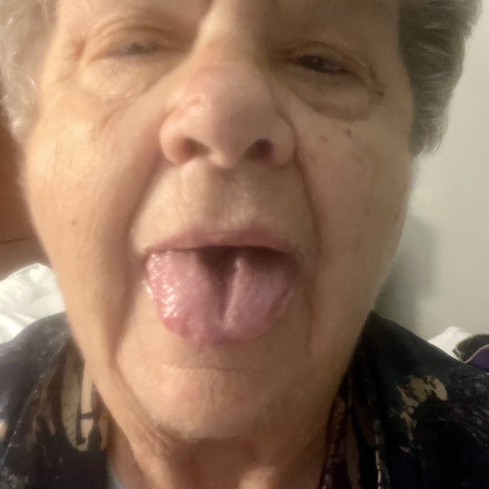 High Desert Dental - Interfered with breathing and swallowing. Emergency dental care needed.  He says the crowns were in alignment. Shame on him. Need lawyer. - General Dentistry Near Me - Albuquerque, New Mexico