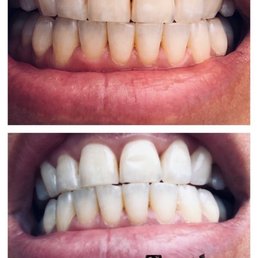 Teeth whitening only one treatment.