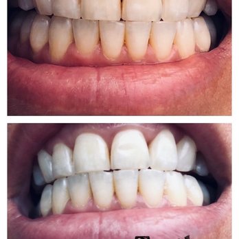 Shape it Up Contouring - Teeth whitening only one treatment. - Skin Care Near Me - Murrieta, California