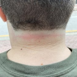 Uptown Barber Shop - Red mark across the back of my neck is the damage that was done by the barber at UPTOWN. The haircut in the photo was NOT their work