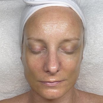 Revive Skin Studio - Nano infusion after glow - Day Spas Near Me - Newtown, Pennsylvania