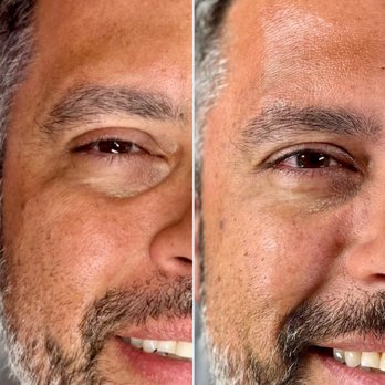 The Best Injector - Before and after Male under-eye correction - Medical Spas Near Me - Delray Beach, Florida The Best Injector - Before and after Male under-eye correction - Medical Spas Near Me - Delray Beach, Florida