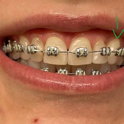 Chicago Pediatric Dentistry & Orthodontics - Teeth not fully aligned yet