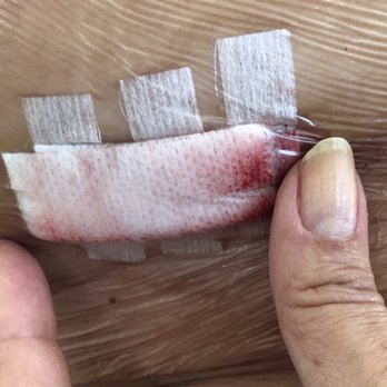 Roy Silver, MD - Surgery one of 3 incisions @DrRoySilvers they wanted me to wait 4 months do remove my 5x twisted ovary - Obstetricians & Gynecologists Near Me - Los Angeles, California Roy Silver, MD - Surgery one of 3 incisions @DrRoySilvers they wanted me to wait 4 months do remove my 5x twisted ovary - Obstetricians & Gynecologists Near Me - Los Angeles, California