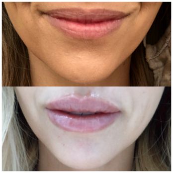 LaserAway - Juvederm - Laser Hair Removal Near Me - Walnut Creek, California LaserAway - Juvederm - Laser Hair Removal Near Me - Walnut Creek, California
