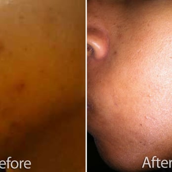 Dabbo Skin Care Studio - Acne? No problem. Dabbo can help. - Skin Care Near Me - Torrance, California Dabbo Skin Care Studio - Acne? No problem. Dabbo can help. - Skin Care Near Me - Torrance, California
