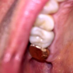 Plum Creek Family Dentistry - Walter glass ruined a perfectly good gold crown to make his crown make contact. Ground the gold crown all the way thru. Refused repair