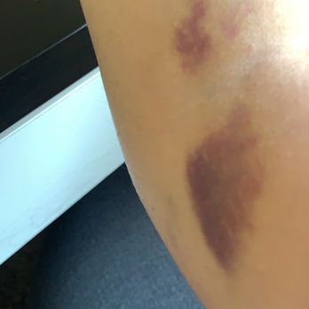 Quest Diagnostics - After my blood test I got this painful clot in 4 hr as they are not trained - Laboratory Testing Near Me - Chino, California