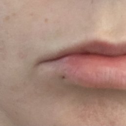 Cut lip Cut lip