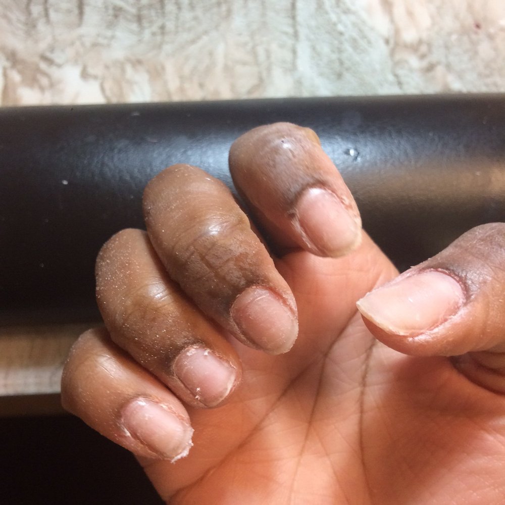 My nails after the 40 minute acetone soak & poor electric filing, and before the "technician" got ready to glue on fake nails My nails after the 40 minute acetone soak & poor electric filing, and before the "technician" got ready to glue on fake nails