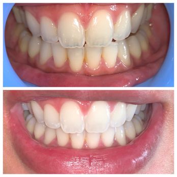 Moe's Teeth Whitening - Teeth Whitening Near Me - El Cajon, California Moe's Teeth Whitening - Teeth Whitening Near Me - El Cajon, California