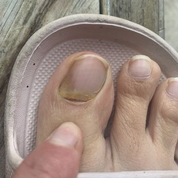 Pretty in Pink Nail Bar - Toe fungus. Nail turning yellow and separating from nail bed. - Nail Salons Near Me - Sugar Land, Texas Pretty in Pink Nail Bar - Toe fungus. Nail turning yellow and separating from nail bed. - Nail Salons Near Me - Sugar Land, Texas