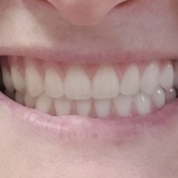 Sage Dental Care - These were NOT done by Sage Dental...this is my new GREAT dentist. - General Dentistry Near Me - Reno, Nevada