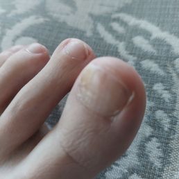Fungus infection from Indulge Nail Salon Fungus infection from Indulge Nail Salon