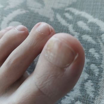 Indulge Nail Spa - Fungus infection from Indulge Nail Salon - Nail Salons Near Me - New Braunfels, Texas Indulge Nail Spa - Fungus infection from Indulge Nail Salon - Nail Salons Near Me - New Braunfels, Texas