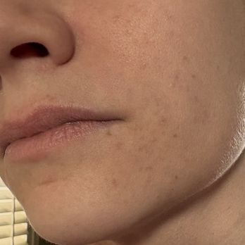 Solutions Skin Care By Kimberly - Dec 26, 2024 after approximately 4 months working with Kimberly; no makeup - Skin Care Near Me - Costa Mesa, California