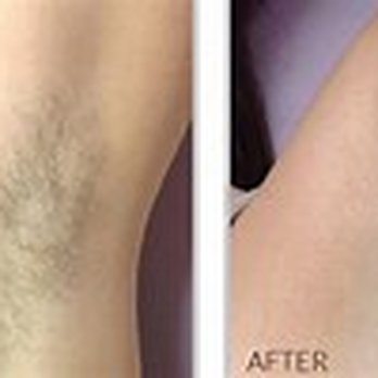 Heritage Threading Salon - laser Before and after - Threading Services Near Me - Brookline, Massachusetts