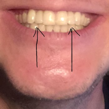 Joseph S Kim, DMD - This the end result!!!!!!!! - Oral Surgeons Near Me - Mountain View, California