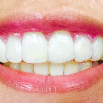 Phan Orthodontics - THANKS FOR MY BEST SMILE DR PHAN! - Orthodontists Near Me - San Jose, California